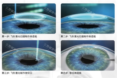 南京市第一医院眼科收费标准公布，近视手术9600元起/白内障5700元起/角膜塑形镜4200元起！