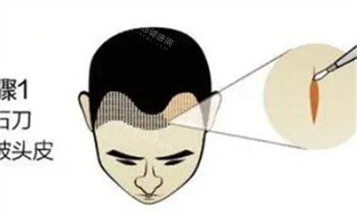 南京植发多少钱？发际线种植6400起、眉毛种植9980起、头顶加密种植11000起