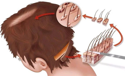 毛囊移植部位演示图