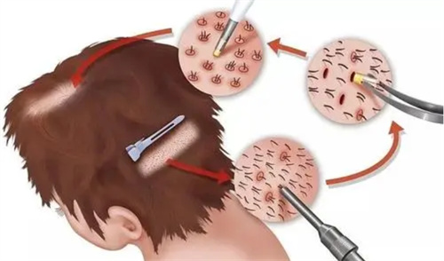 毛发移植手术动画图