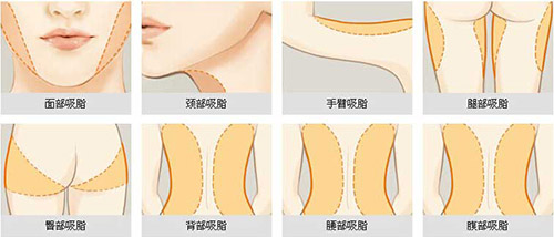 吕光全腰腹吸脂怎么样?分层吸脂技术+细腻操作,助你重塑平坦小腹小蛮腰