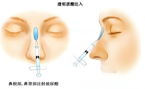 隆鼻玻尿酸注射图