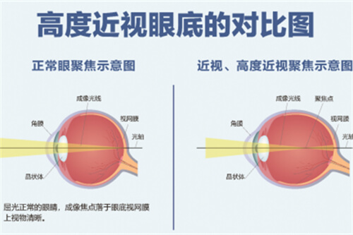 北京大学人民医院眼科收费贵吗？将各项检查费用/激光近视/配镜改善/白内障/眼底病价格揭秘！