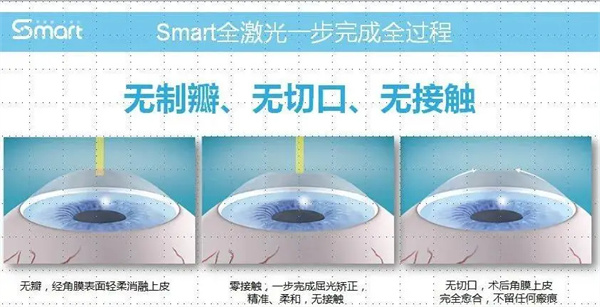 smart全激光手术过程图