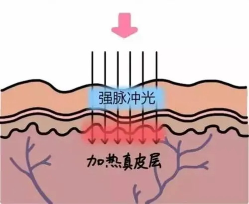 光子嫩肤针对的皮肤层