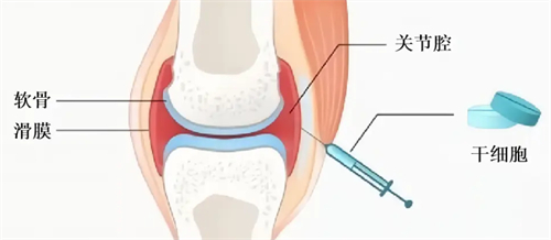 关节炎治疗过程