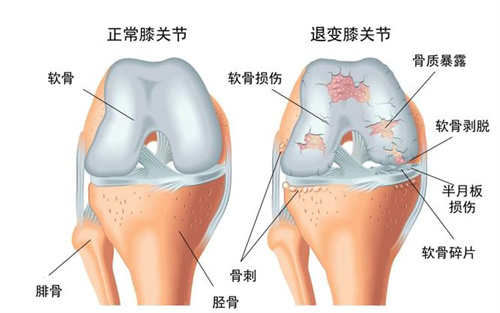 膝骨关节炎