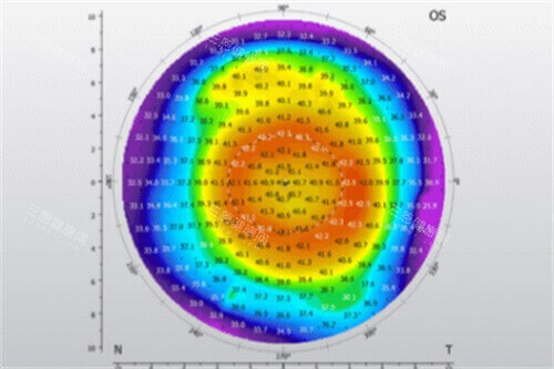 角膜地形图