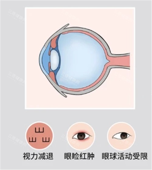 眼球突出照片