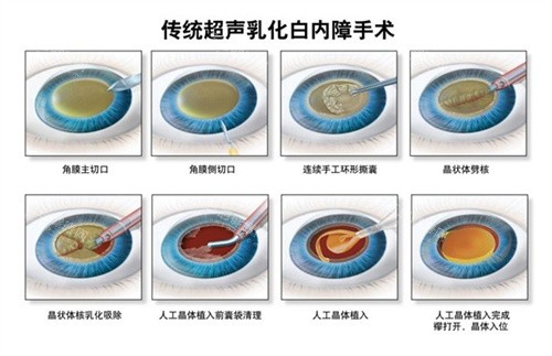 超声乳化白内障手术