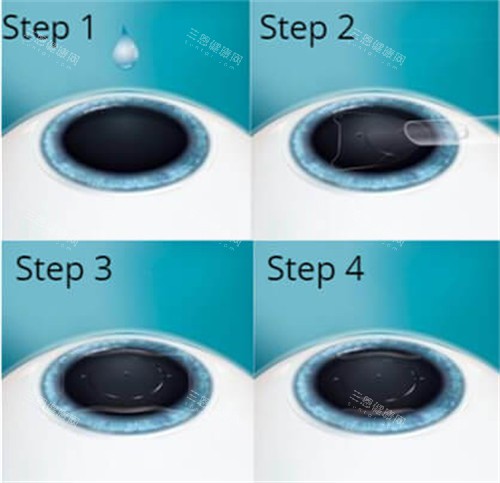 晶体植入手术过程演示图