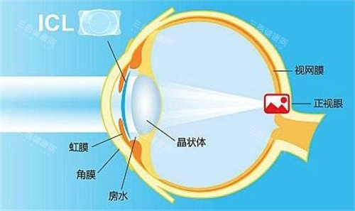 近视眼手术晶体植入大概多少钱?参考价格约2~5万元不等，因晶体类型|近视度数及眼部状态等而有价格浮动~