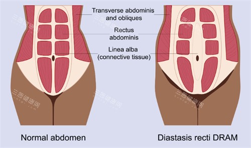 腹壁成形改善肌肉