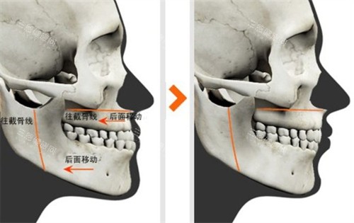 双鄂手术对比图