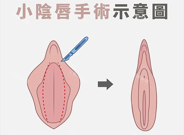 小阴唇整形前后对比