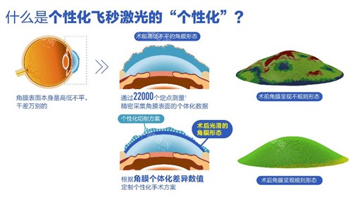 个性化微飞秒手术过程图解