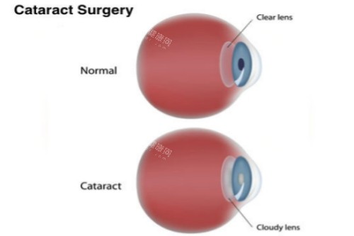 正常眼与白内障眼对比