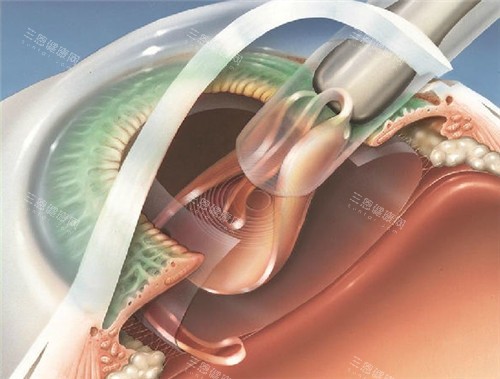 白内障手术细节图