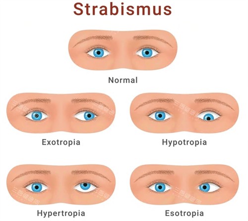 斜视手术不同症状