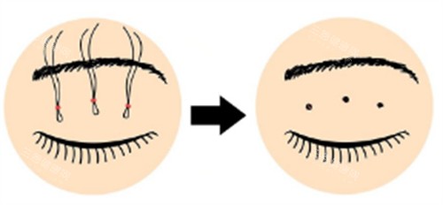 皮下速接双眼皮操作过程图解